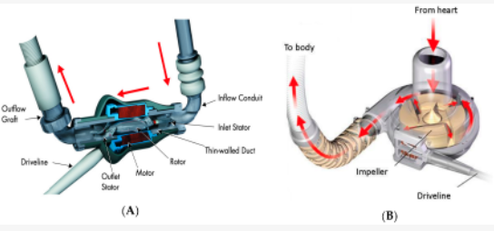 Study Finds that Concurrent Tricuspid Valve Surgery and Left